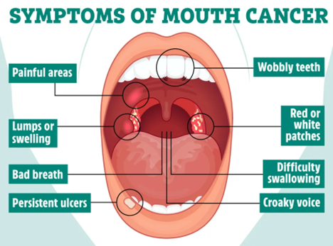 Symptoms of Mouth Cancer